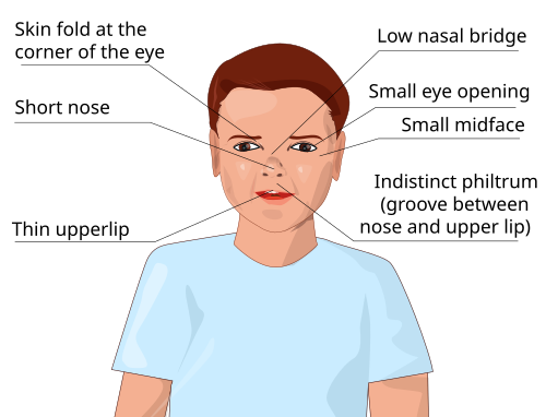 علامات متلازمة الكحول الجنينية