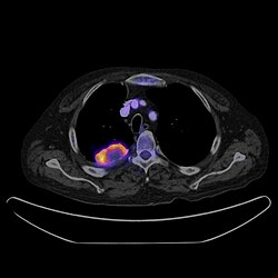 صورة مدمجة PET-CT