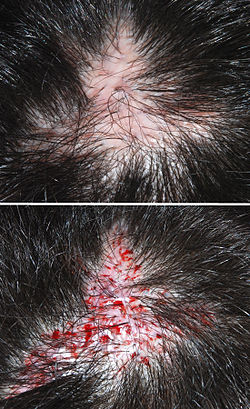 زراعة الشعر: الدليل الشامل للتقنيات والنتائج